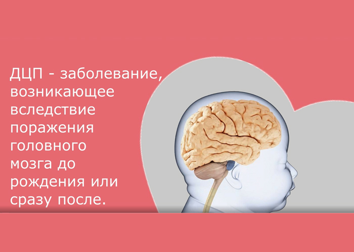 ДЦП. КАК С ЭТИМ ЖИТЬ